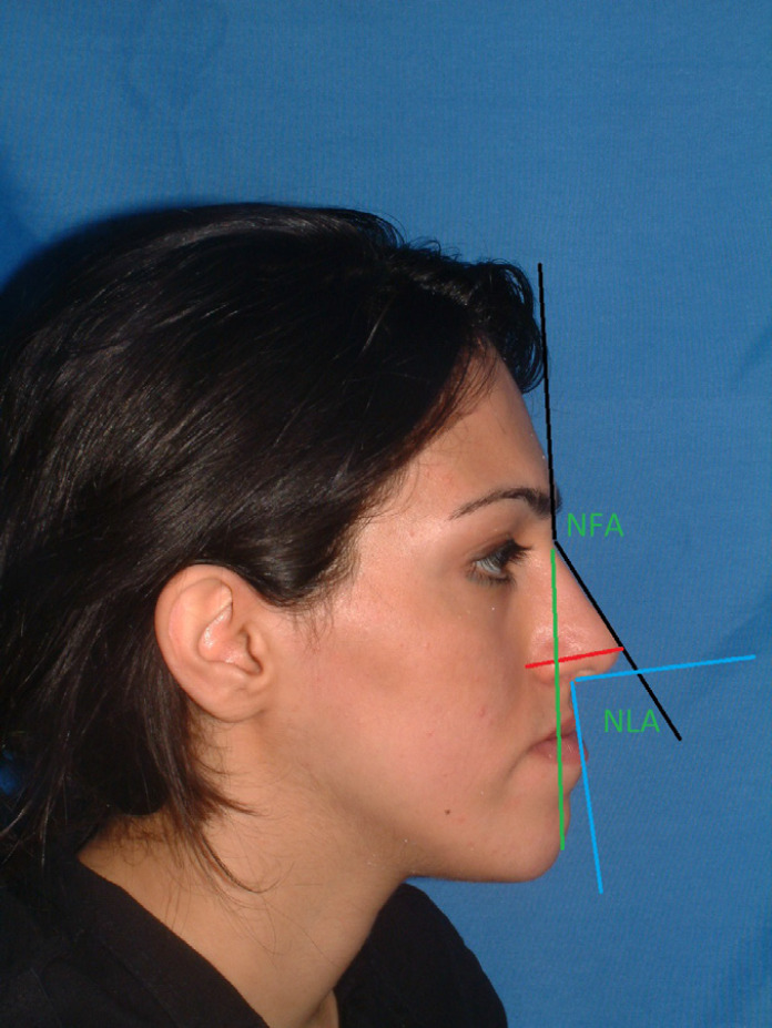 Patients Satisfaction and Nasal Morphologic Change after Orthognathic Surgery.