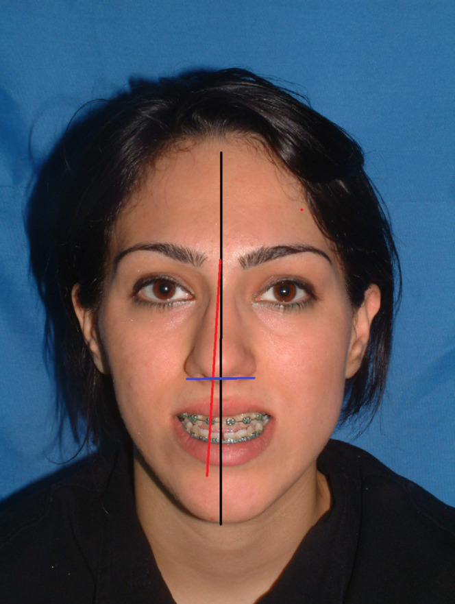 Patients Satisfaction and Nasal Morphologic Change after Orthognathic Surgery.