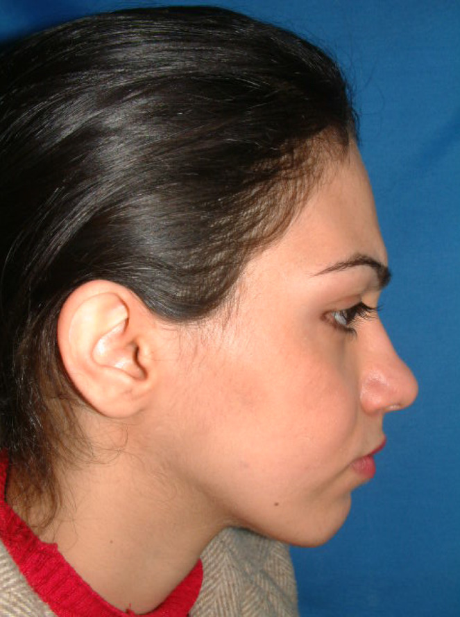 Patients Satisfaction and Nasal Morphologic Change after Orthognathic Surgery.