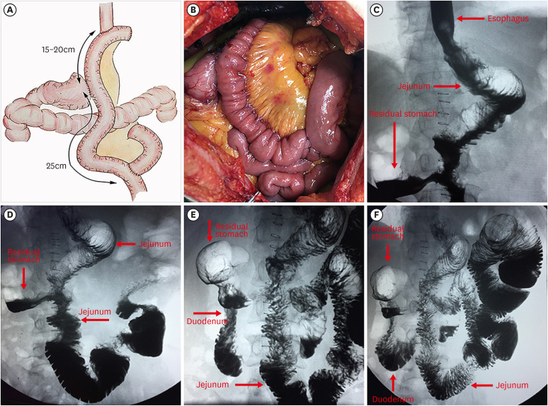 Clinical Comparison of Proximal Gastrectomy With Double-Tract Reconstruction Versus Total Gastrectomy With Roux-en-Y Anastomosis for Siewert Type II/III Adenocarcinoma of the Esophagogastric Junction.