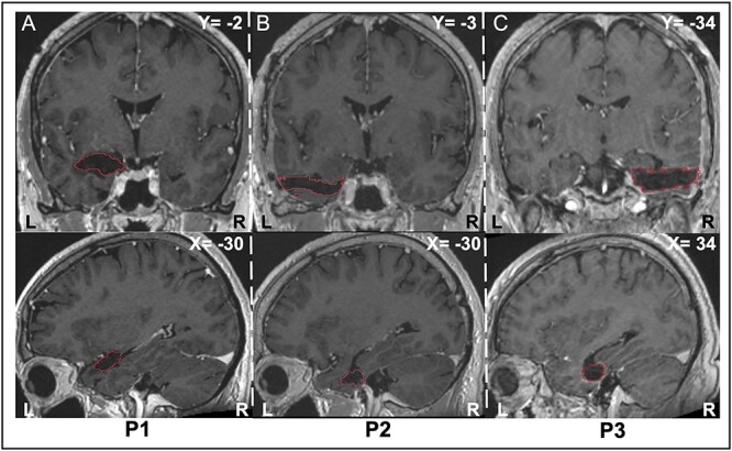 Personal space regulation is affected by unilateral temporal lesions beyond the amygdala.