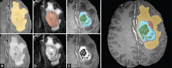 Brain Tumor Segmentation using Hierarchical Combination of Fuzzy Logic and Cellular Automata.