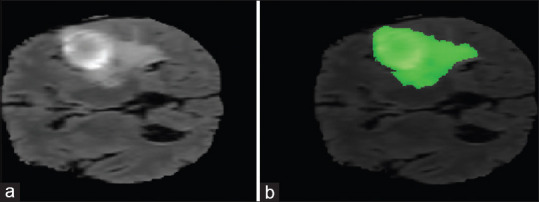 Brain Tumor Segmentation using Hierarchical Combination of Fuzzy Logic and Cellular Automata.