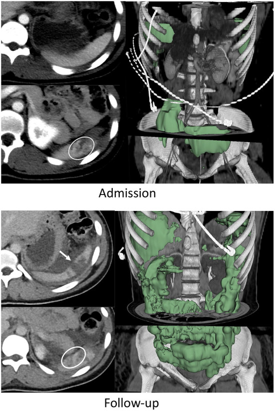 Blunt splenic injury: Assessment of follow-up CT utility using quantitative volumetry.