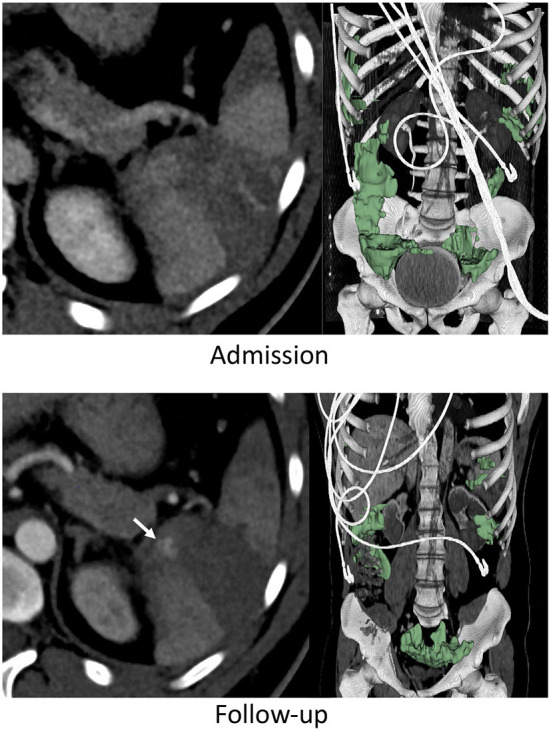 Blunt splenic injury: Assessment of follow-up CT utility using quantitative volumetry.