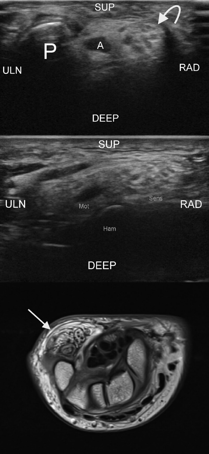 Ultrasound of Lipomatosis of Nerve Associated with Macrodactyly: 'Spaghetti and Chocolate Cookie' Appearance.