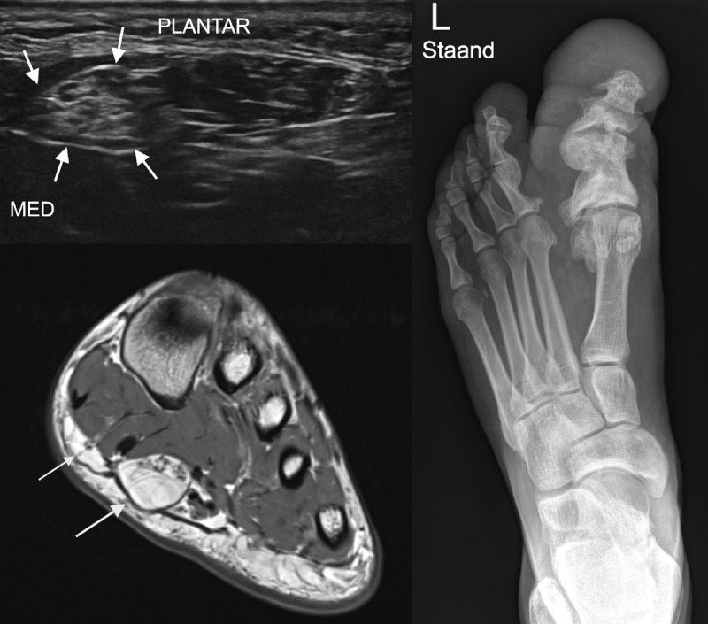 Ultrasound of Lipomatosis of Nerve Associated with Macrodactyly: 'Spaghetti and Chocolate Cookie' Appearance.