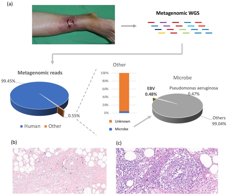 Metagenomic Sequencing and Histology on a Chronic Wound Identified Epstein-Barr Virus-Associated Lymphoma.