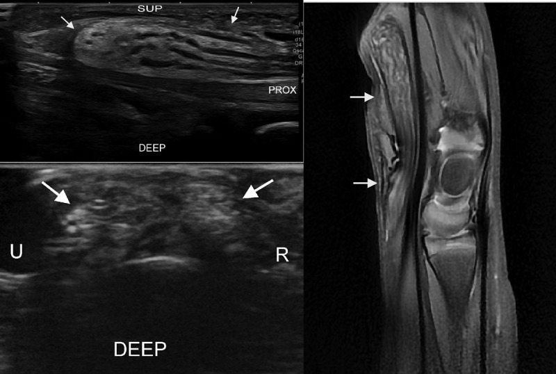 Ultrasound of Lipomatosis of Nerve Associated with Macrodactyly: 'Spaghetti and Chocolate Cookie' Appearance.