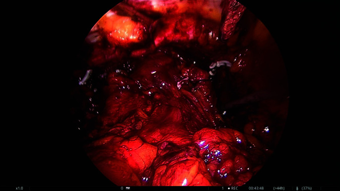 Multiple Endoclip Retraction Technique (MERT) in Laparoscopic Burch.