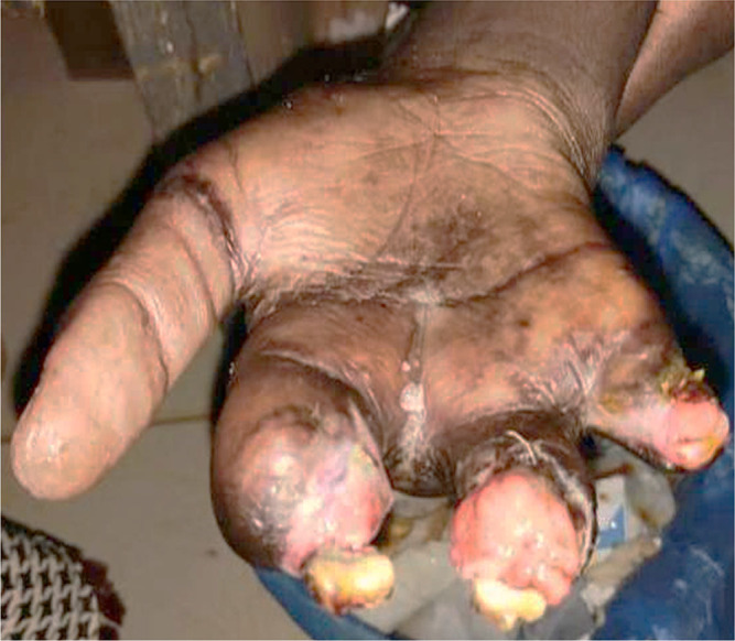 Rheumatoid Vasculitis, an Uncommon Complication of Non-Deforming Rheumatoid Arthritis: A Case Report.