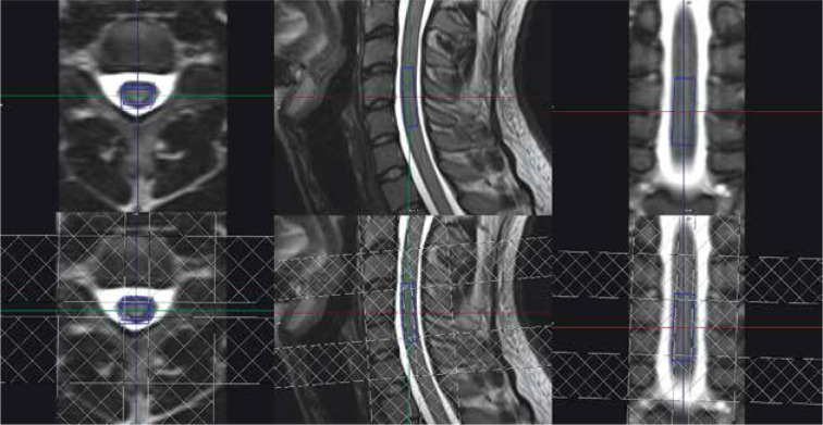 Evaluation of 3T proton MR spectroscopy in the spinal cord - preliminary results.