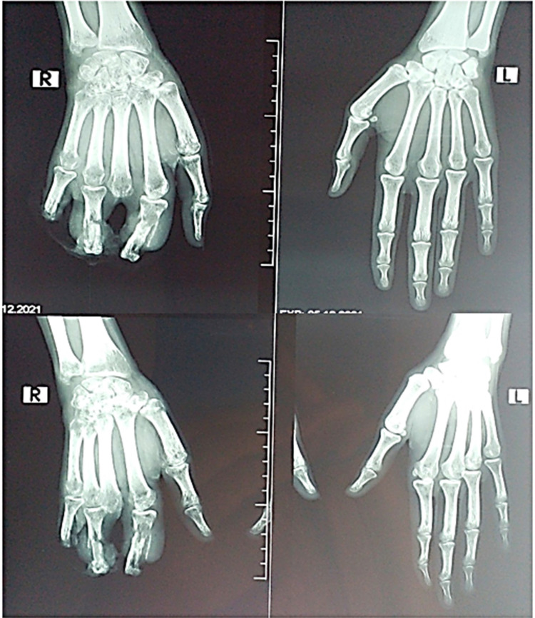 Rheumatoid Vasculitis, an Uncommon Complication of Non-Deforming Rheumatoid Arthritis: A Case Report.