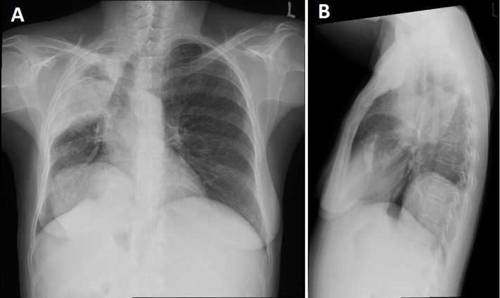 A rare presentation of multi-organ hydatid disease: Case report and review of the literature.