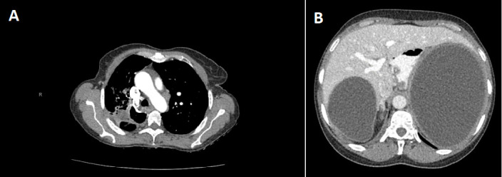 A rare presentation of multi-organ hydatid disease: Case report and review of the literature.