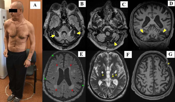 A rare case of neurosyphilis presenting as generalized dystonia with bilateral cerebellar infarctions.
