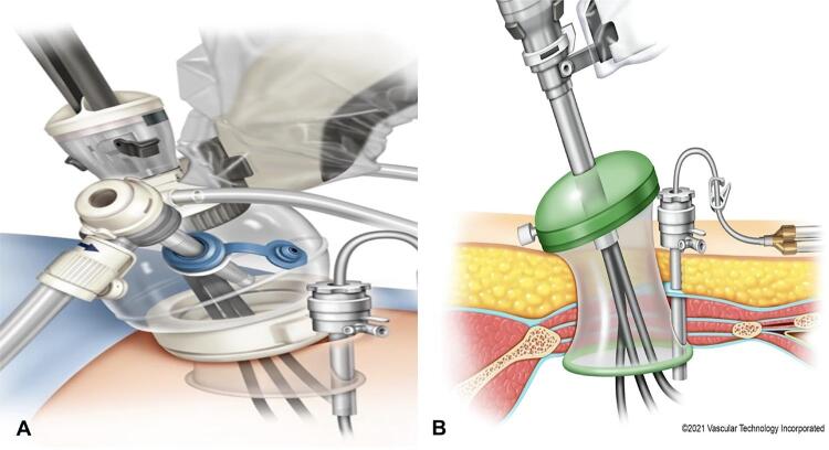 Contemporary techniques of da Vinci SP radical prostatectomy: multicentric collaboration and expert opinion.