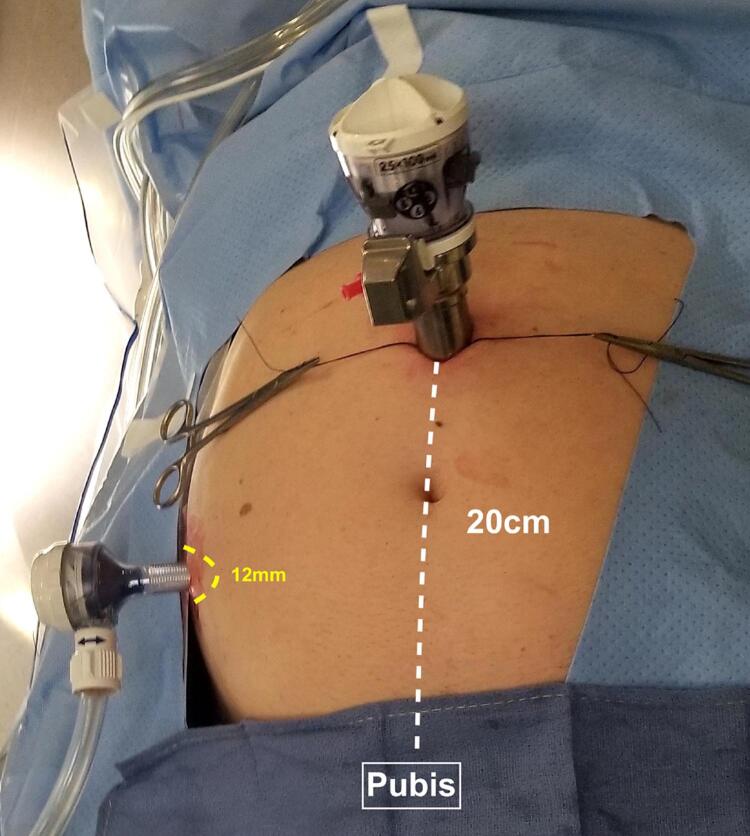 Contemporary techniques of da Vinci SP radical prostatectomy: multicentric collaboration and expert opinion.