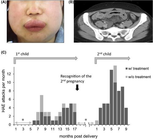 Successful management of hereditary angioedema with icatibant during the postpartum period