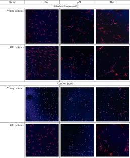 Age-Associated Features of the Expression Level of Apoptosis Markers in Cardiomyocytes of Patients with Dilated Cardiomyopathy