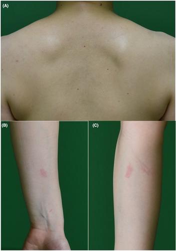 Prior antihistamine agent successfully impaired cutaneous adverse reactions to COVID-19 vaccine