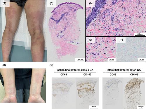 A case of patch granuloma annulare with CD68-negative, CD163-positive M2 macrophages infiltration in an interstitial pattern