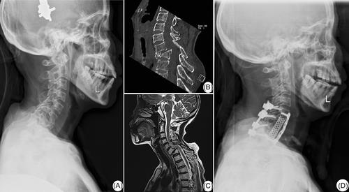 Surgical treatment was desirable to improve neuromuscular function in patients with sustained 3 years fracture-dislocation of lower cervical spine: A case report