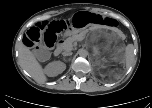 Long-Term Outcomes of Congenital Adrenal Hyperplasia.