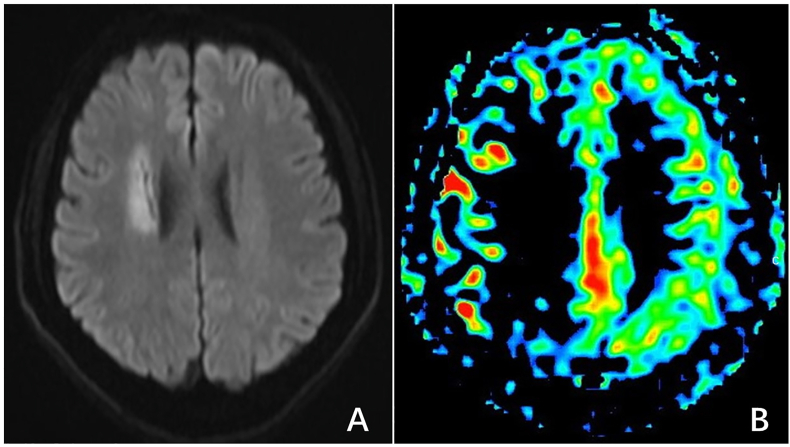 Primary balloon angioplasty for chronic occlusion of intracranial internal carotid artery: A case report