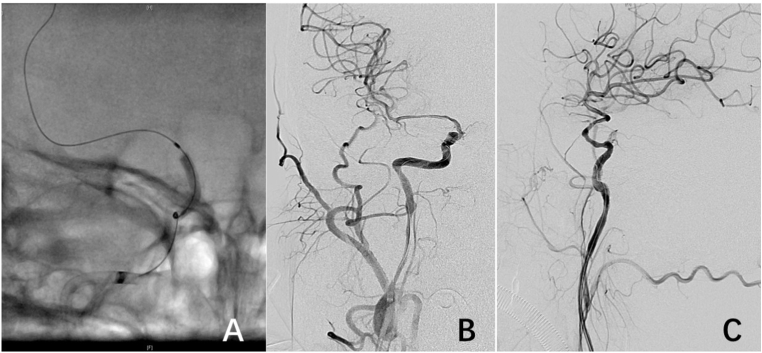 Primary balloon angioplasty for chronic occlusion of intracranial internal carotid artery: A case report