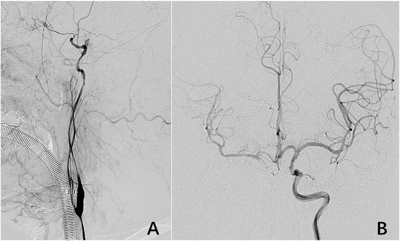 Primary balloon angioplasty for chronic occlusion of intracranial internal carotid artery: A case report