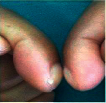 Hypertrophic Osteoarthropathy Associated with Probable Smear-Negative Pulmonary Tuberculosis.