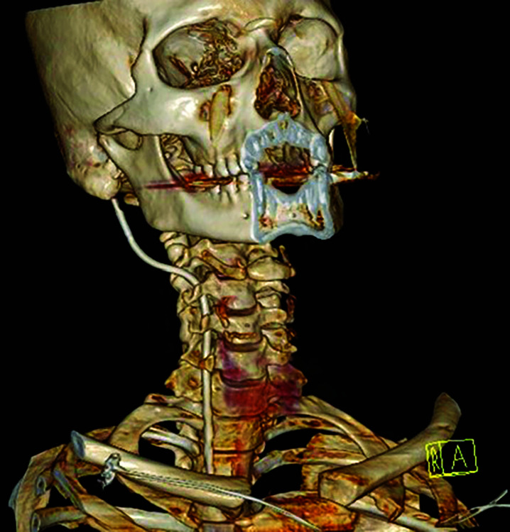 Inadvertent Vertebral Vein Cannulation: Anatomical Considerations and Practical Aspects.