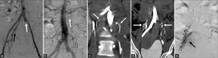 Catheter-directed computed tomography angiography: A pictorial essay.