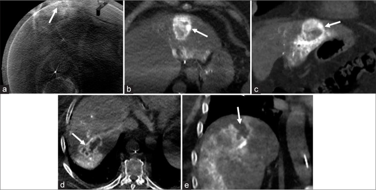 Catheter-directed computed tomography angiography: A pictorial essay.