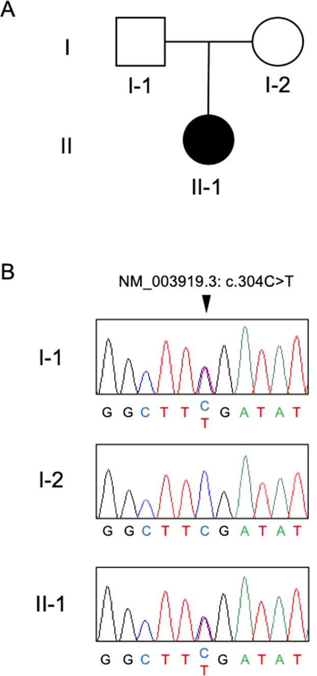 A Japanese family with dystonia due to a pathogenic variant in SGCE.