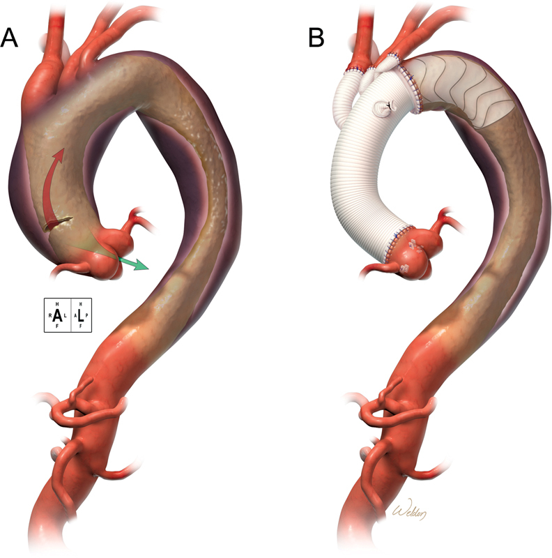 Optimal Extent of Repair for Acute Type I Aortic Dissection-Frozen Elephant Trunk? How Long and Why?