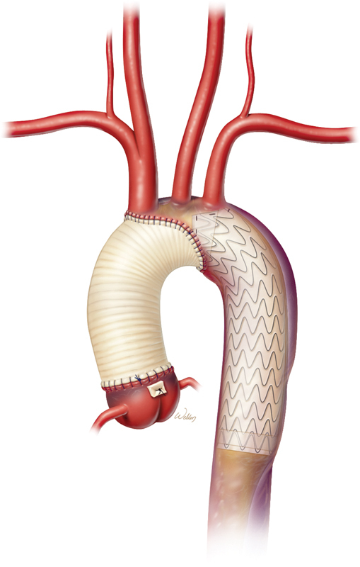 Optimal Extent of Repair for Acute Type I Aortic Dissection-Frozen Elephant Trunk? How Long and Why?