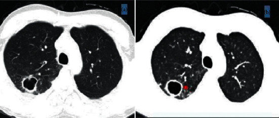 Hypertrophic Osteoarthropathy Associated with Probable Smear-Negative Pulmonary Tuberculosis.