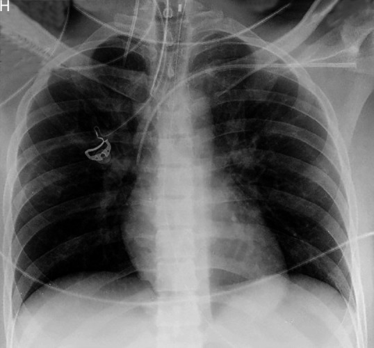 Inadvertent Vertebral Vein Cannulation: Anatomical Considerations and Practical Aspects.