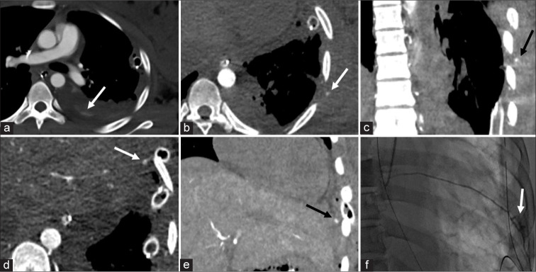 Catheter-directed computed tomography angiography: A pictorial essay.