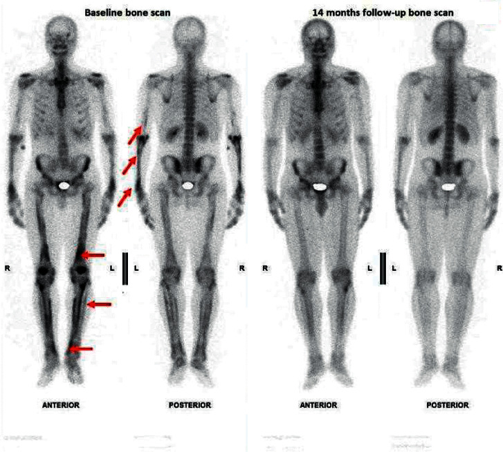 Hypertrophic Osteoarthropathy Associated with Probable Smear-Negative Pulmonary Tuberculosis.