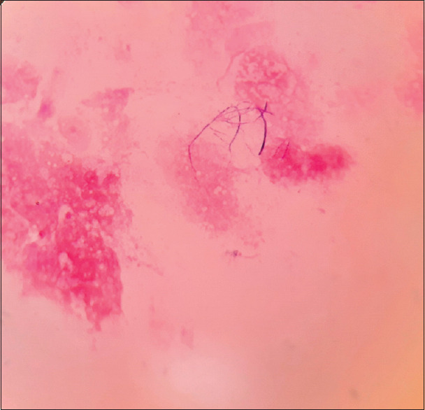 Gram Staining: A Simple Effective Tool for Diagnosis of Nocardiosis.