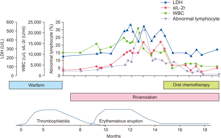 Thrombophlebitis Migrans As the Prodrome of Adult T-Cell Leukemia-Lymphoma.