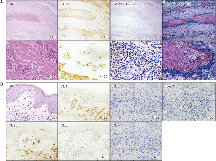 Thrombophlebitis Migrans As the Prodrome of Adult T-Cell Leukemia-Lymphoma.