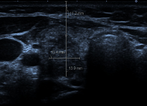 Ultrasound-Guided Fine Needle Aspiration of Deep Thyroid Nodule: Is There a Correlation between the Nodule's Depth and Nondiagnostic Results?