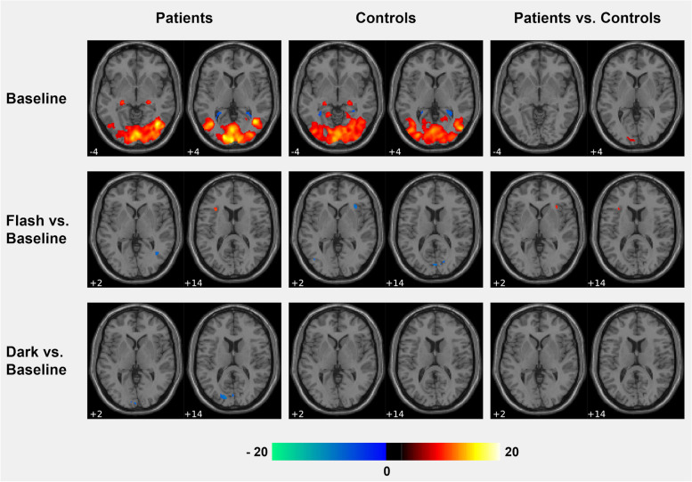 Avoid or seek light - a randomized crossover fMRI study investigating opposing treatment strategies for photophobia in migraine.