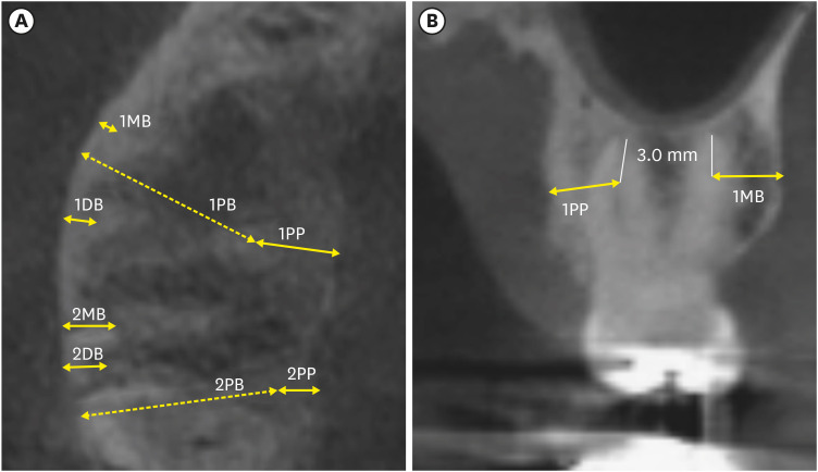 Proximity of maxillary molar apexes to the cortical bone surface and the maxillary sinus.