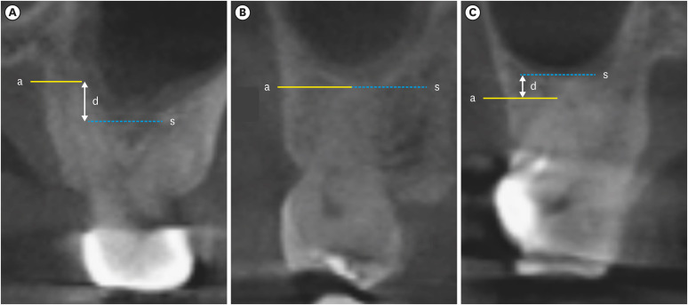 Proximity of maxillary molar apexes to the cortical bone surface and the maxillary sinus.