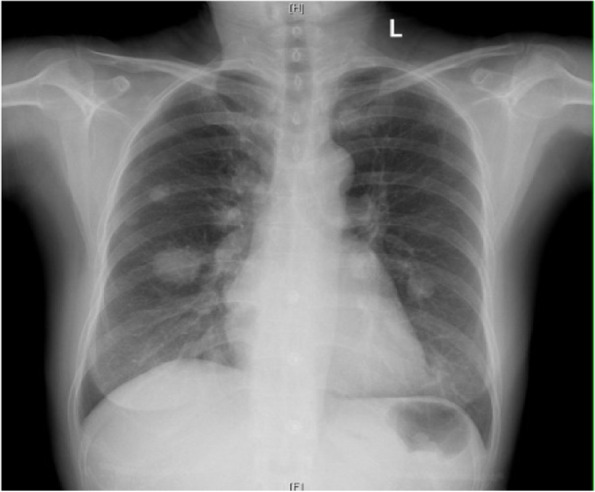 Primary gliosarcoma with widespread extracranial metastases-spatiotemporal morphological variation.